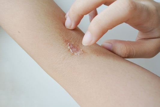 Managing Impetigo: Tips for Keeping Your Skin Healthy