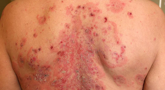 Pemphigus: Symptoms, Development, Cure and Management