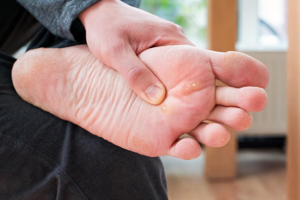 The Causes, Symptoms, and Treatments of Warts