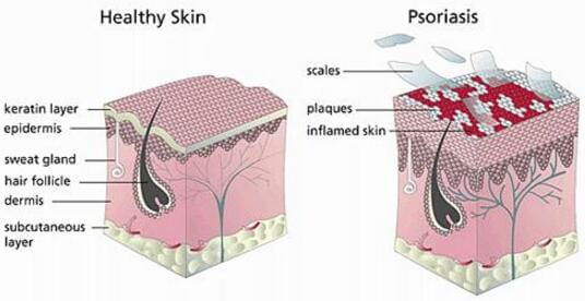 What is Psoriasis, How does it develop, Cure and management
