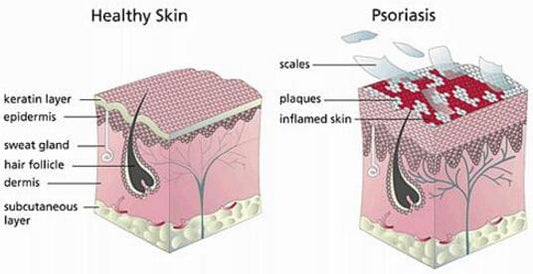 What is Psoriasis, How does it develop, Cure and management