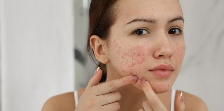 The Dilemma of Acne: Symptoms, Development, Cure, and Management