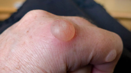 Blisters Disease: Causes, Symptoms, Treatment & Prevention