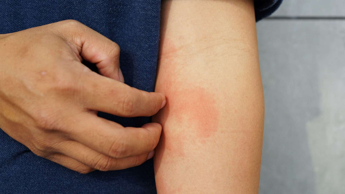 Understanding Eczema: Causes, Symptoms, and Treatment