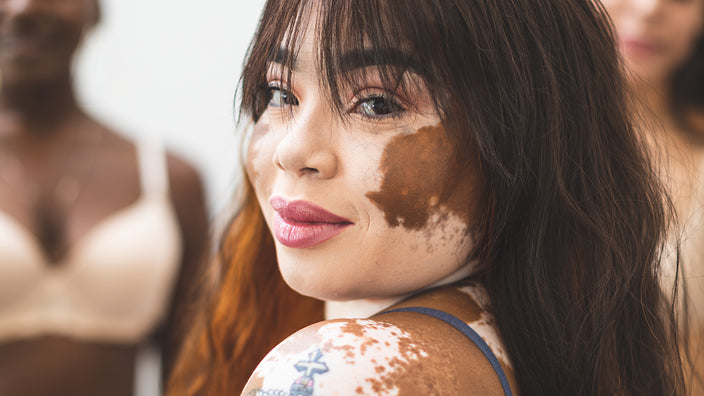 Vitiligo: A Skin Condition That Affects Millions