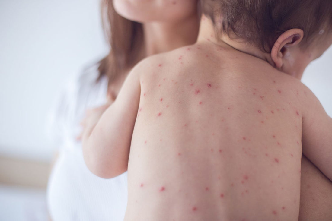 Measles: Uncovering the Truth Behind the Disease