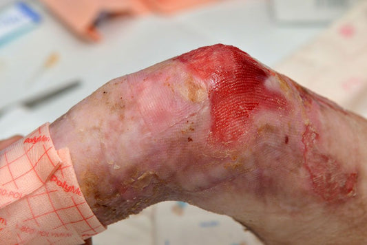 Understanding Epidermolysis Bullosa: Symptoms, Development, Cure, and Management