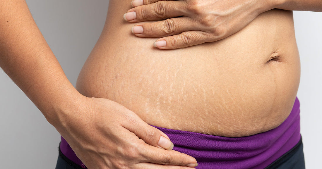 Are stretch marks creams really helpful?