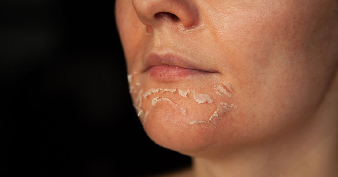 Put Your Best Face Forward: Peeling Away the Impurities