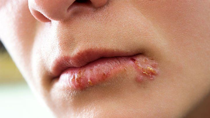 Everything You Need to Know About Cold Sores
