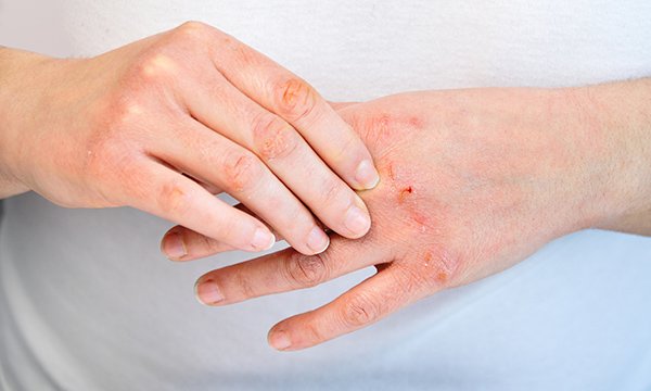 mage of contact dermatitis, a skin condition characterized by inflammation and irritation caused by contact with an irritant or allergen.