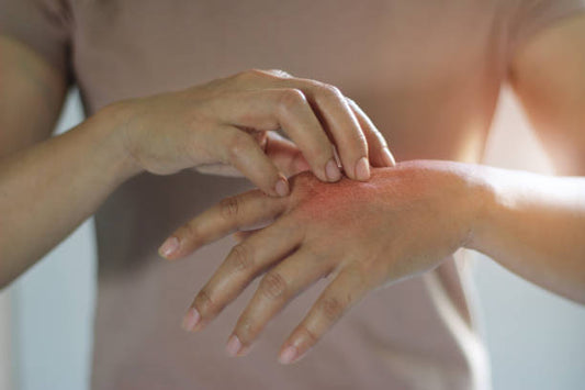 Ketokem Anti-Fungal Soap: Gentle Relief for Fungal Skin Infections