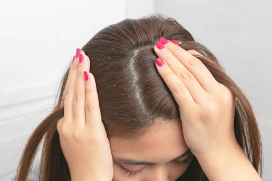 Danfree 2% Shampoo - Experience Freedom from Dandruff with Powerful Anti-Dandruff Solution