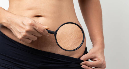 Sanfe Intimate Stretch Mark Oil Review, side effects, benefits