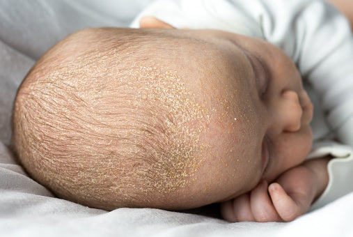 Close-up view of Seborrheic Eczema on the scalp showing red, flaky patches and dandruff-like flakes