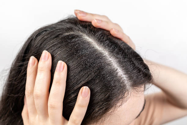 Dandruff: Causes, Treatments and Home Remedies