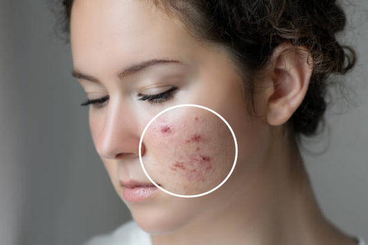 Unveiling the Power of Aura Secrets Acne Control Face Wash: Your Key to Clear, Radiant Skin