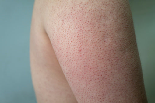 Exploring the Treatment Options for Keratosis Pilaris