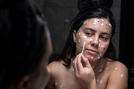Image of girl with chickenpox, a highly contagious viral infection causing an itchy rash with fluid-filled blisters. Common in children, but adults who have not had it before can also be affected.