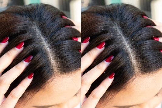 WOW Skin Science Hair Mask Anti-Dandruff: Say Goodbye to Dandruff and Hello to Healthy Hair