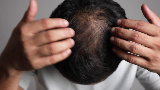 APPECIA-F5%: In-Depth Review of Minoxidil Finasteride Topical Solution