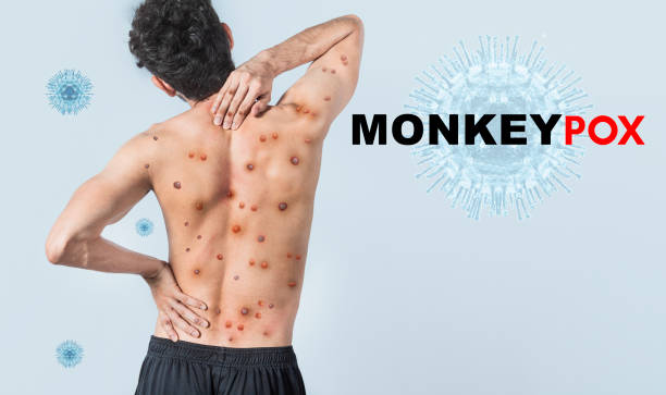 An Introduction to Monkeypox: Symptoms, Transmission, and Prevention