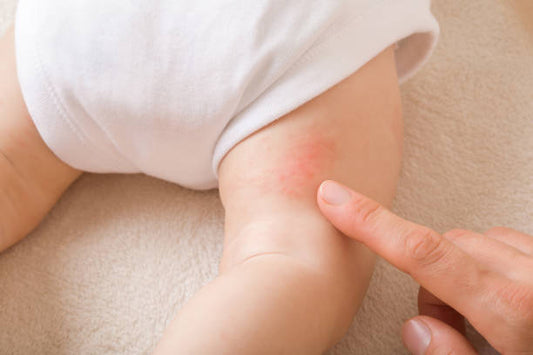 How can parents soothe common discomforts such as diaper rash in babies?