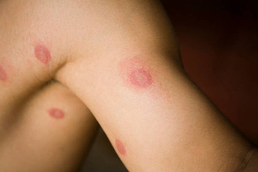 LEEBORD Daad Ka Brahmastra: Your Solution for Ringworm