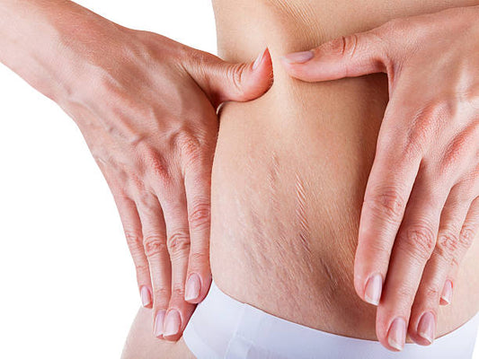 Eradicating Stretch Marks: Understanding Causes, Treatments, and Prevention