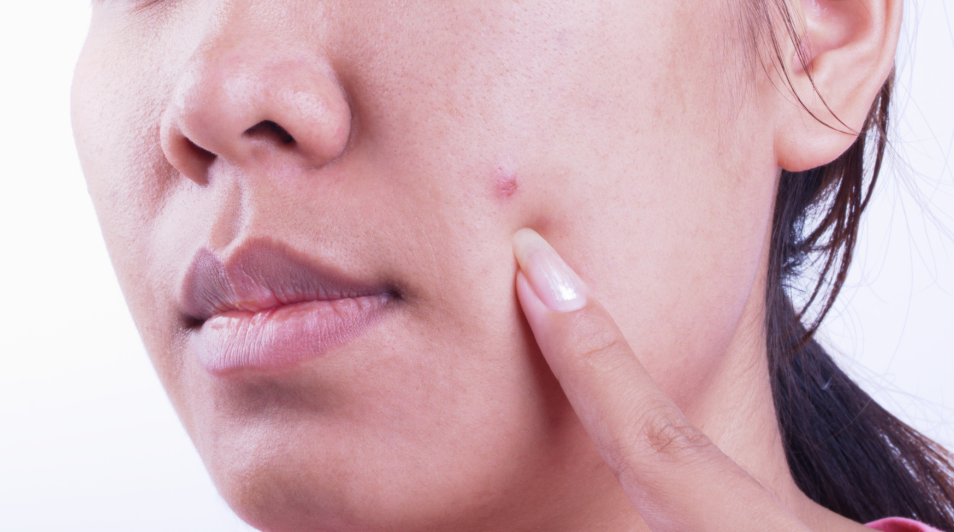 A Comprehensive Guide to Basal Cell Carcinoma: Symptoms, Causes, Diagn ...