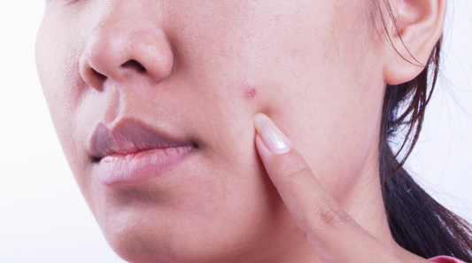 A Comprehensive Guide to Basal Cell Carcinoma: Symptoms, Causes, Diagnosis and Treatment