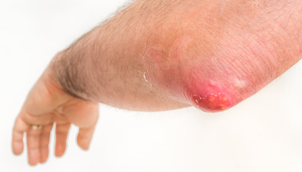 Carbuncle Disease: Causes, Symptoms, and Treatment – Caresupp.in