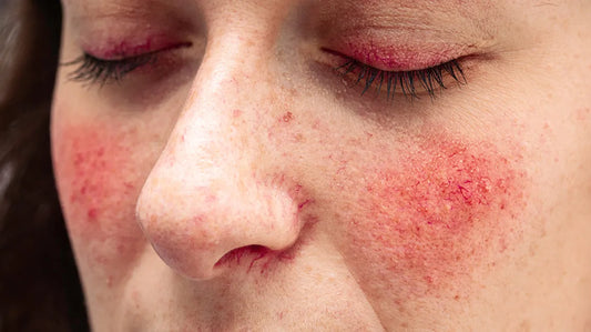 Rosacea: Understanding the Symptoms, Treatment and Management