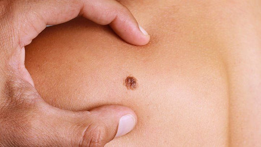 Understanding the Stages of Melanoma Development
