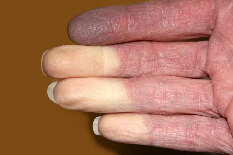 Raynaud's Phenomenon: What the Research Says