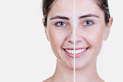 Acne Derma Allantion & Vitamin-E soap for Oily and Acne Prone skin